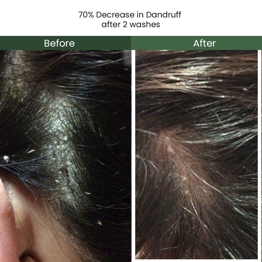 Calm Anti Dandruff Shampoo with Nasturtium Extract, Piroctone Olamine, & Biotin