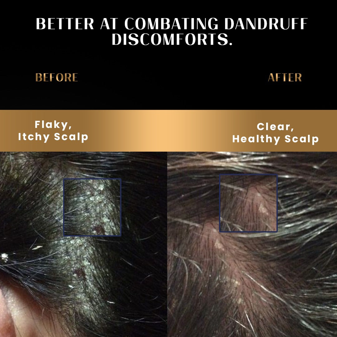 Dandruff Control Shampoo and Conditioner Combo with Nasturtium and Biolipid Complex